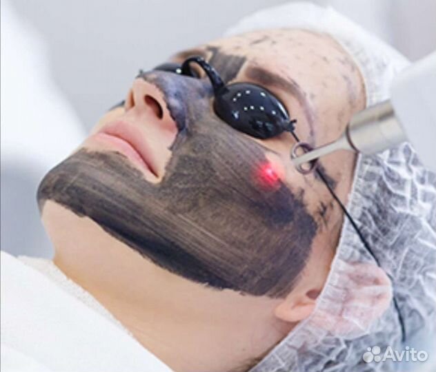 Лазерная эпиляция