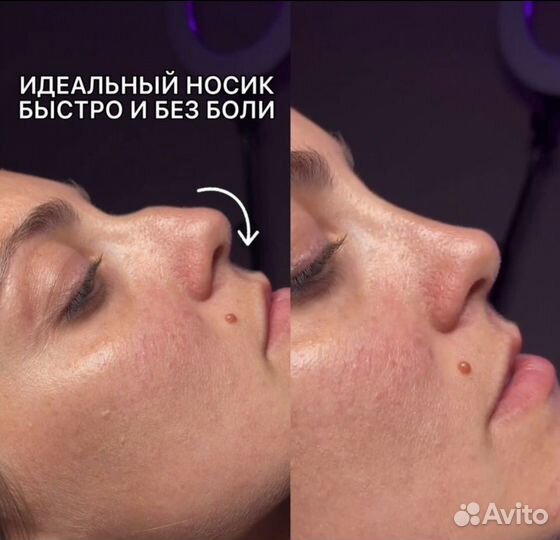 Уменьшение носа безоперационная ринопластика