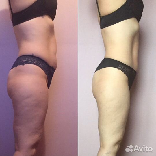 Массаж LPG и Шугаринг