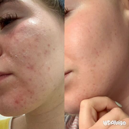 Пилинг для лица