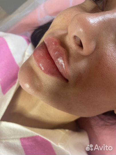 Увеличение губ