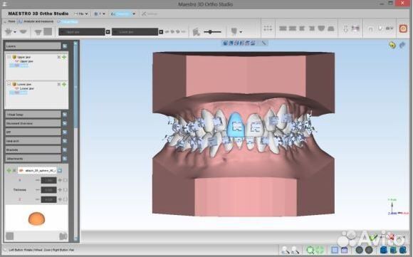 Maestro 3D dental studio 5.2 и 6 версия