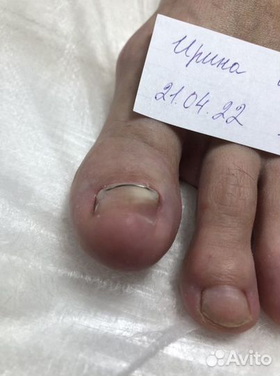 Установка титановой нити, зачистка онихолизиса