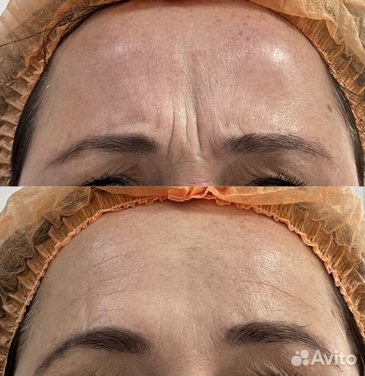 Ботокс для лица