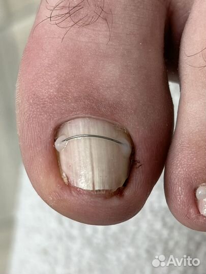 Установка коррекционной системы