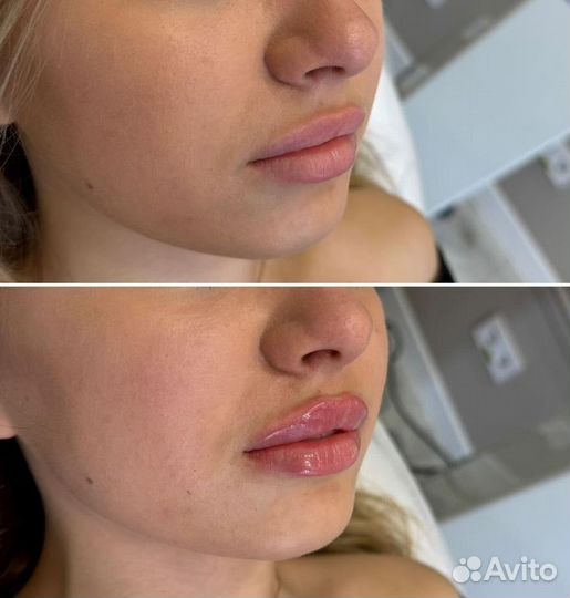 Увеличение губ Скидка 50%