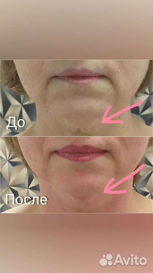 Миофасциальный + скульптурный массаж лица