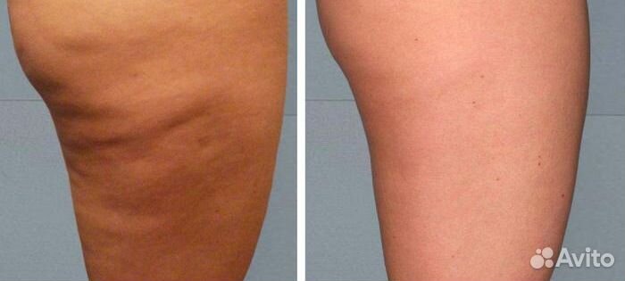 Аппаратный массаж,коррекция фигуры