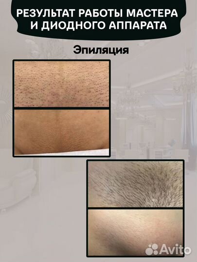 Диодный лазер 808 нм для эпиляции в кредит