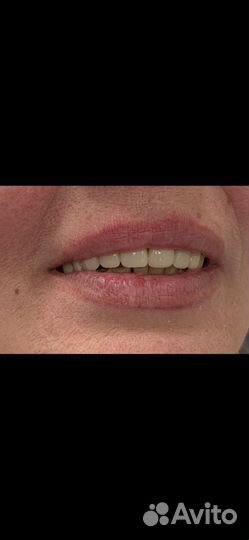 Зубной техник съемное протезирование