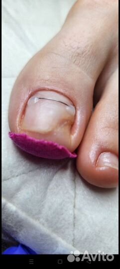 Педикюр подолог, вросший ноготь