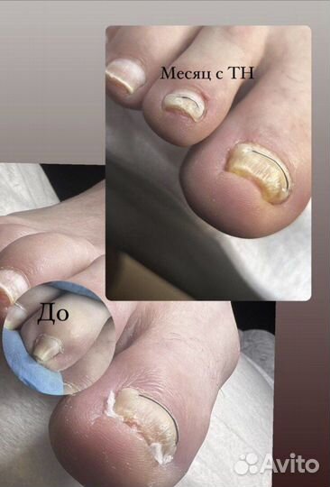 Подолог.Вросший ноготь.Грибок.Мозоль.Бородавки