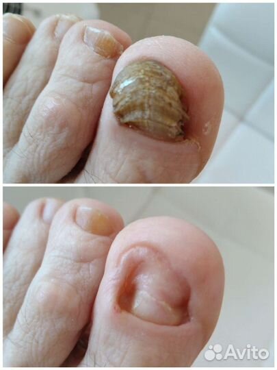 Аппаратный педикюр