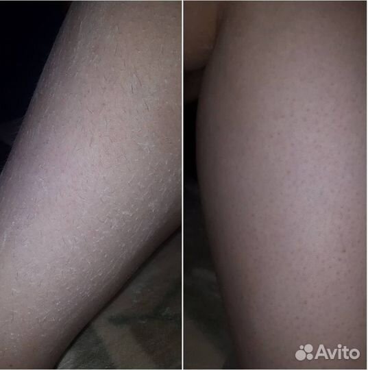 Шугаринг, удаление волос сахарной пастой