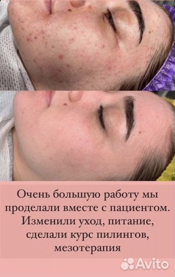 Косметолог чистка лица лечение акне