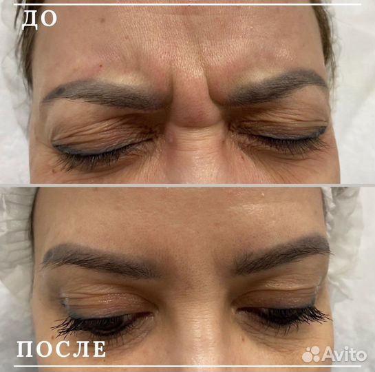 Ботулинотерапия