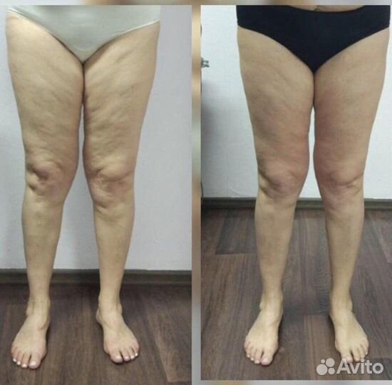 LPG Массаж и Косметология