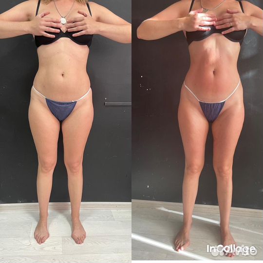 Вакуумный массаж кавитация rf