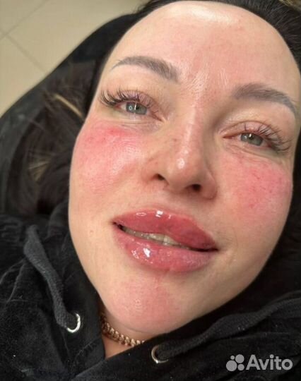 Увеличение губ,мезотерапия лица