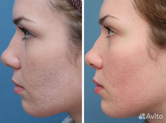 Карбоновый пилинг