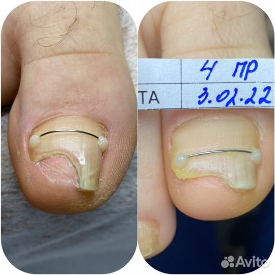 Вросший ноготь Подолог Педикюр