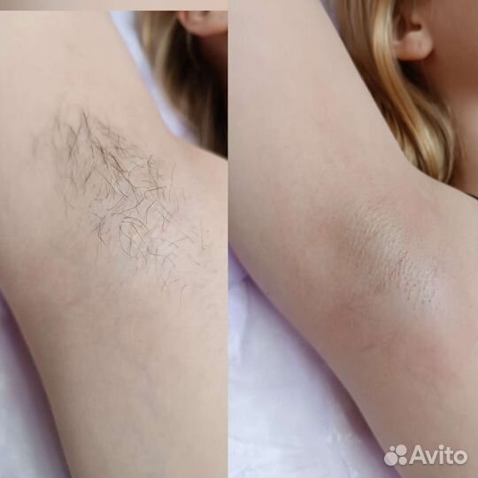 Депиляция шугаринг