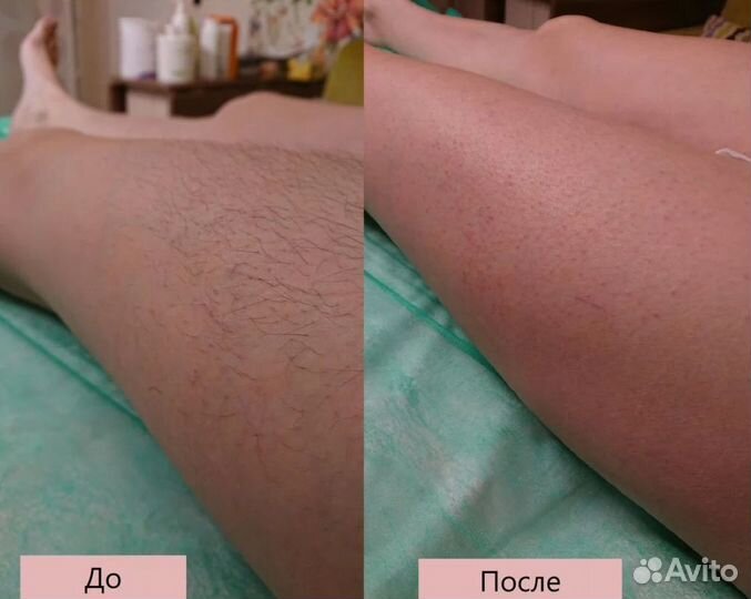 Эпиляция шугаринг