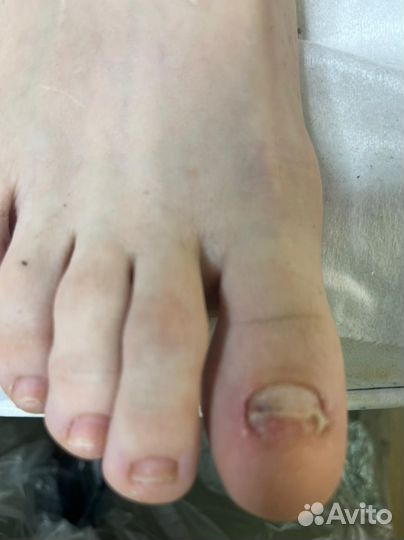 Педикюр подолог