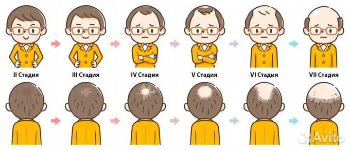 Пересадка волос