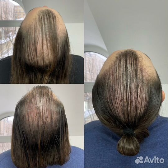 Татуаж Залысина Трихопигментация (камуфляж/тату )