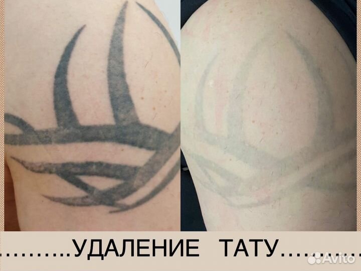 Удаление тату лазером