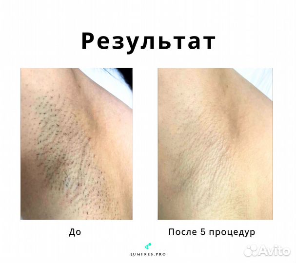 Диодный лазер для эпиляции Lumines Max’One 1200вт