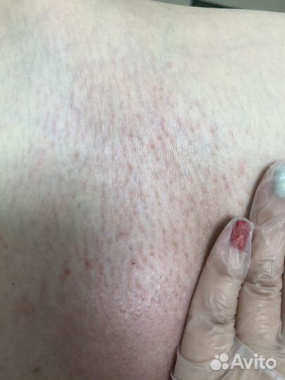 Шугаринг быстро и без боли