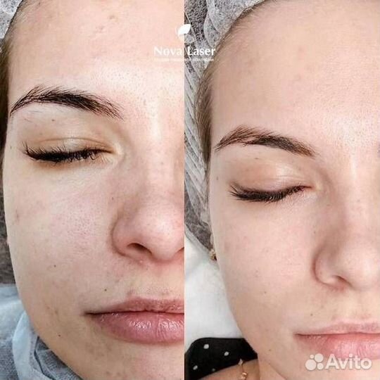 Карбоновый пилинг