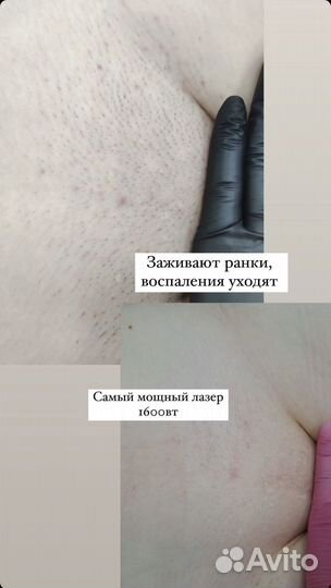 Лазерная эпиляция