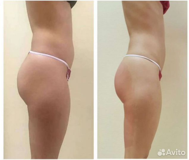 Аппарат Индиба (indiba) Похудение, омоложение