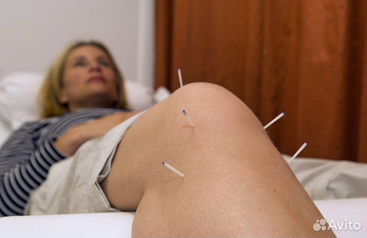 Иглоукалывание