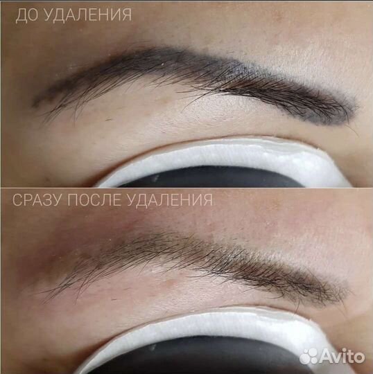 Лазерное удаление тату