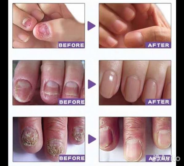 Ногтевое противогрибковое средство