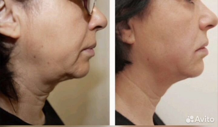 Смас лифтинг/микроигольчатый RF лифтинг