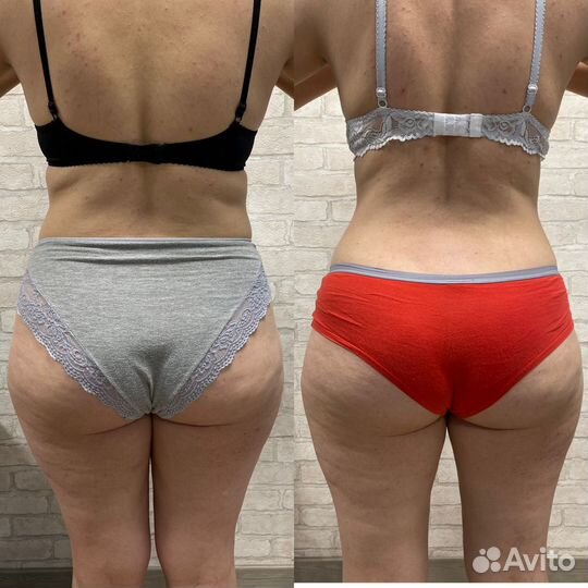 Криолиполиз в Красноярске