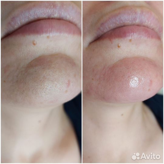 Услуги косметолога чистка лица пилинг