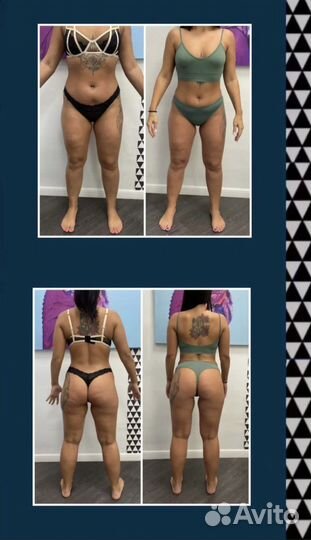 Массаж Vela Shape (LPG) 4 зоны 40 минут