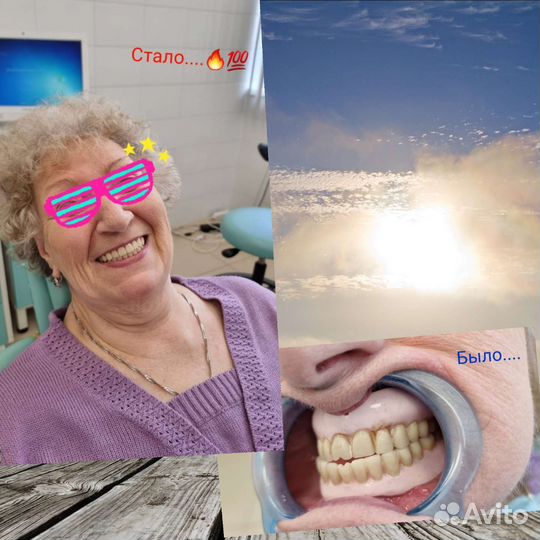 Починки зубных протезов