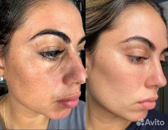 Мезотерапия в сети студий Skine Line -50%