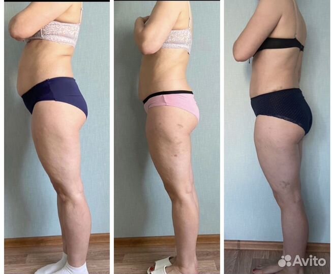 Антицеллюлитный массаж