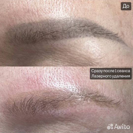 Удаление татуажа/тату ремувером/лазером, Перманент