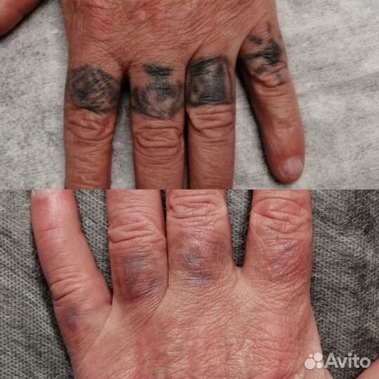 Лазерное удаление татуировок/татуажа