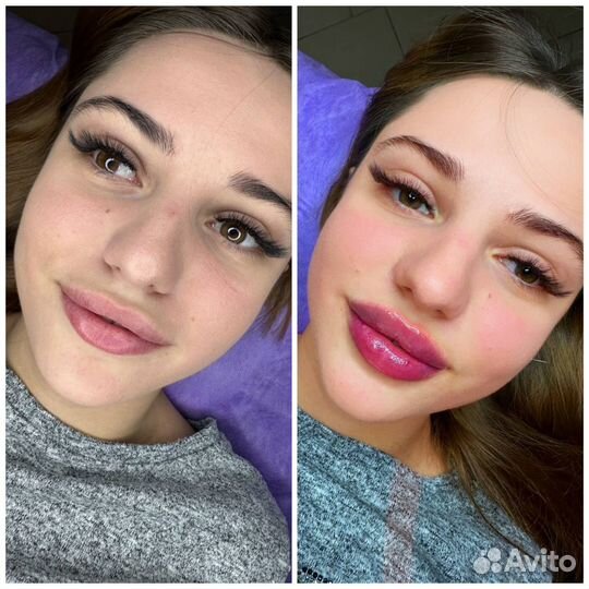 Увеличение губ