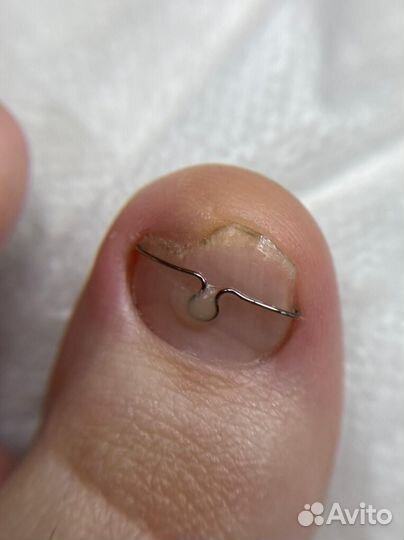 Ищу моделей с вросшим ногтем